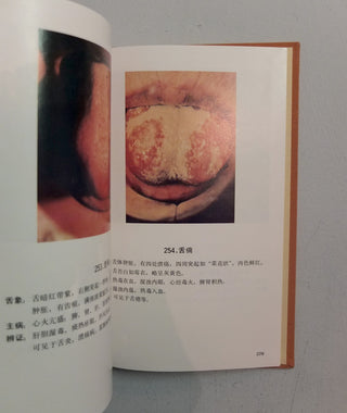 Catalogue of Tongue Coating Diagnoses in Chinese Medicine by People's Medical Publishing House}